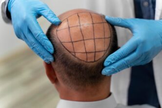 baldness